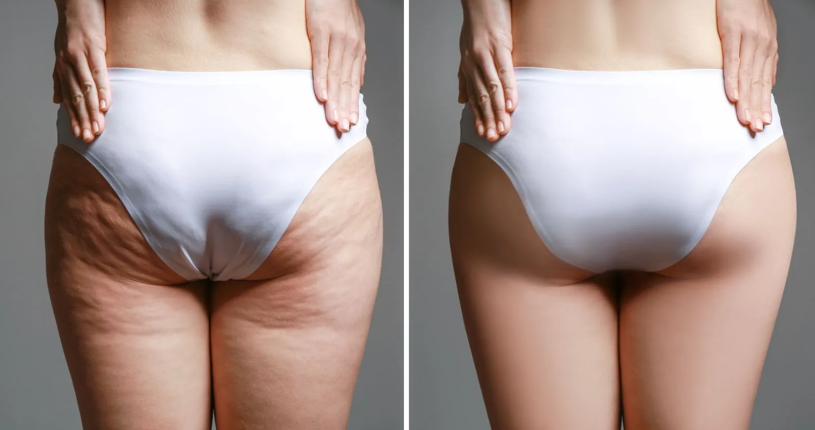 kältekammer gegen cellulite