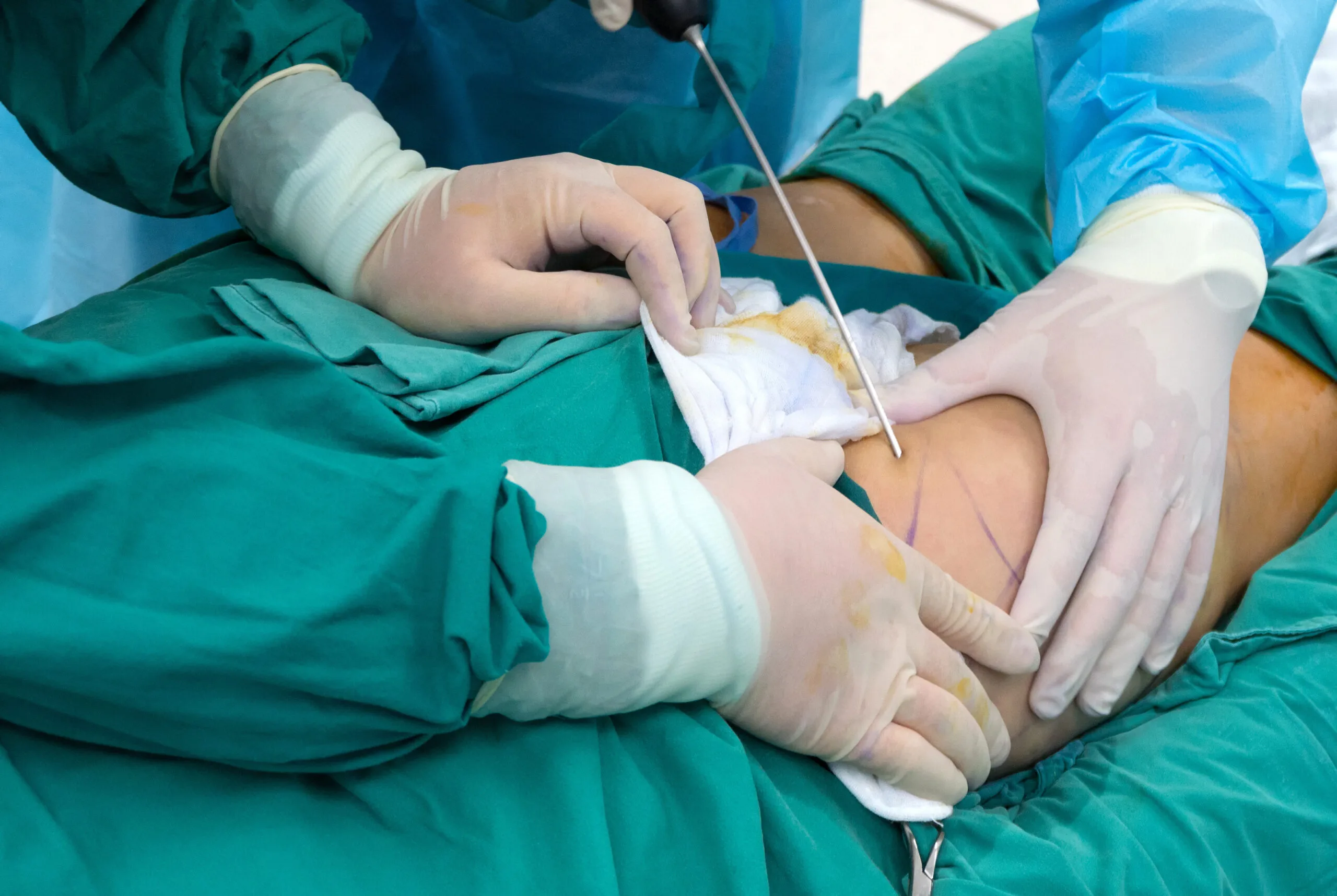 lipödem operation