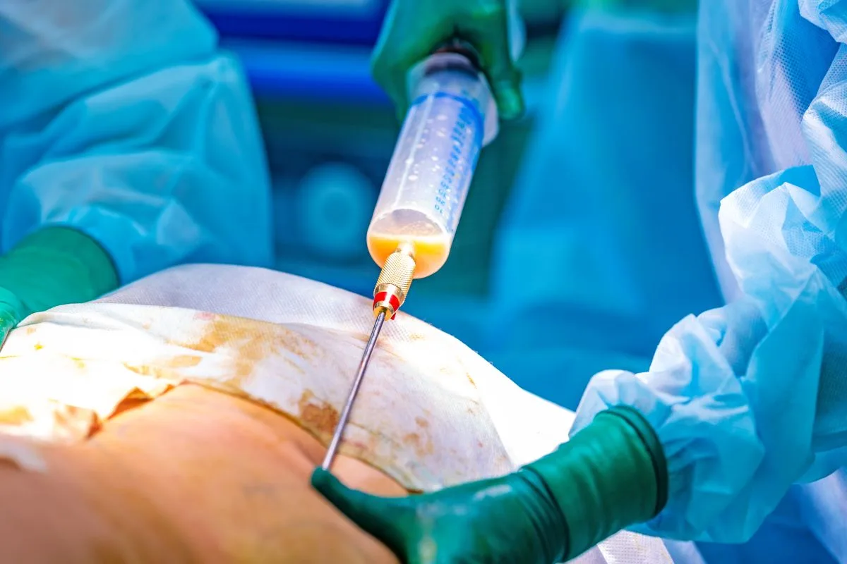 liposuktion bei lipödem